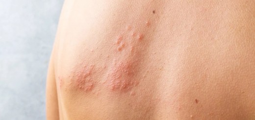 Lherpes zòster sacostuma a manifestar en forma derupcions cutànies molt doloroses, fins i tot incapacitants